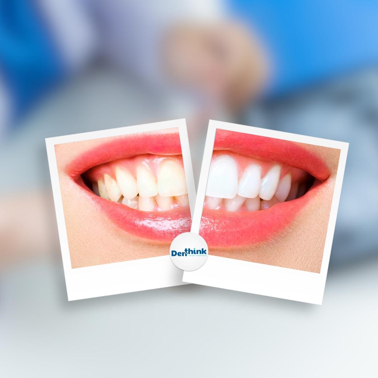 Blue Modern Teeth Whitening Instagram Post